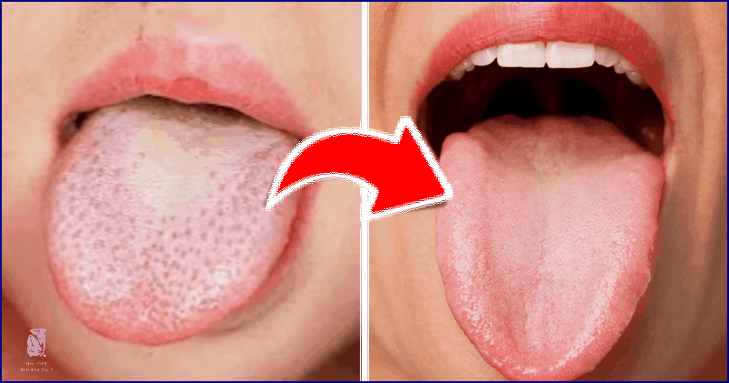 Bílý Povlak: Co To Na Mandlích Znamená?!