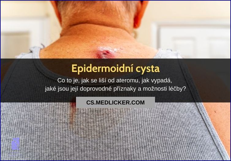 Co Je To Cysta? Tady Je Odpověď!
