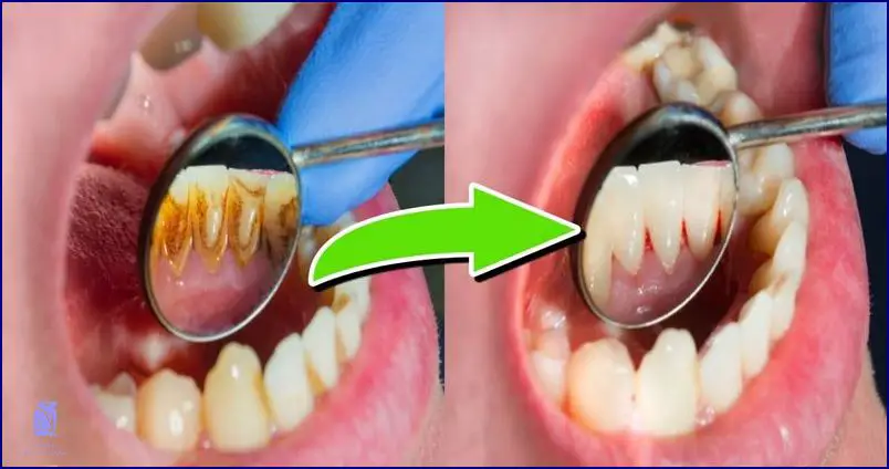 Jak Odstranit Zubní Kámen Sodou? To je Snadné!