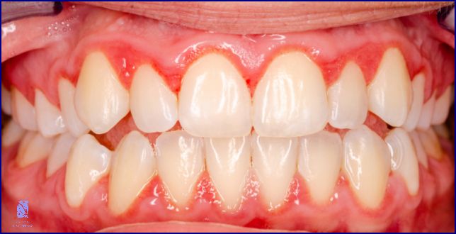 Jak Poznat Zánět Po Vytržení Zubu? Tady je Odpověď!