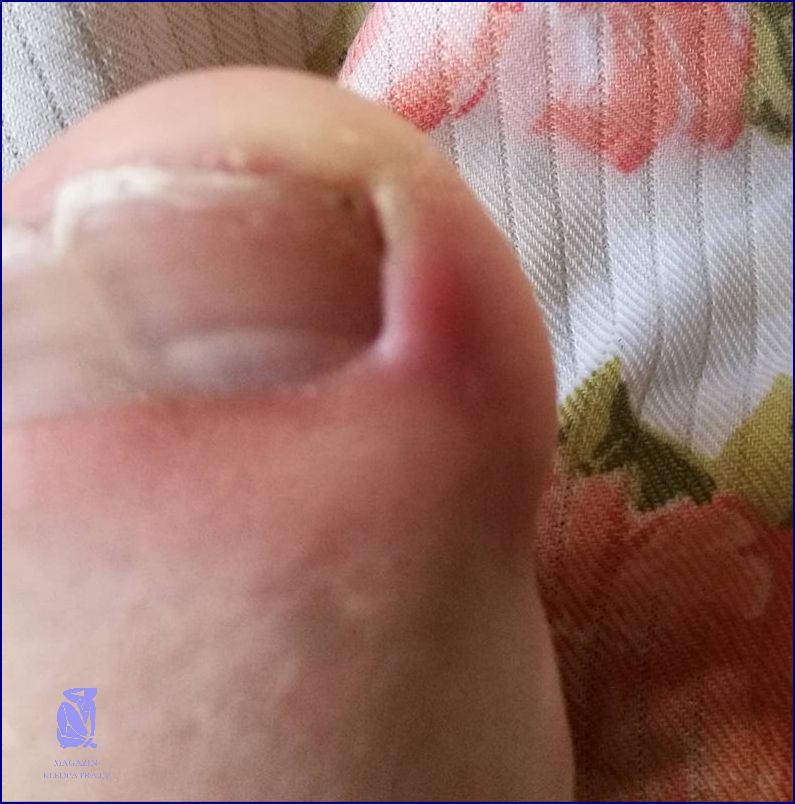 Jak Se Rázem Zbavit Otoku Po Včelím Bodnutí?