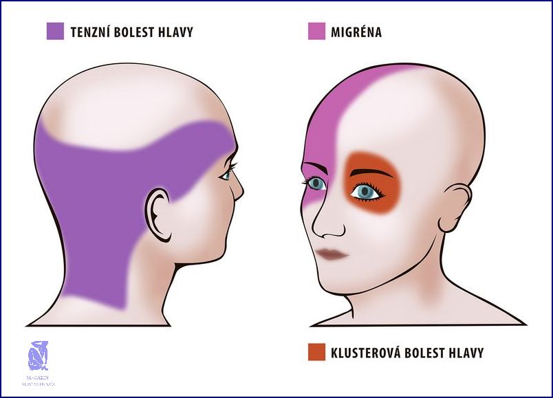Jak Zmírnit Bolest Zadní Části Hlavy?
