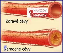 Přírodní Léčba na Překyselení Žaludku!