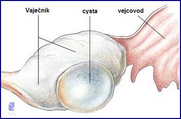 Už Víte, Jak Dlouho Bolí Prasklá Cysta?