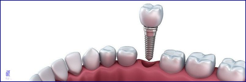 Zubní Implantáty Hrazené Pojišťovnou: Už Nejsou Drahé!