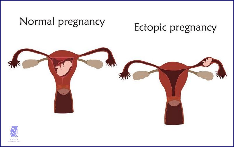 Jak Poznat Mimoděložní Těhotenství?